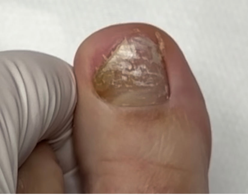 Fungal Nail