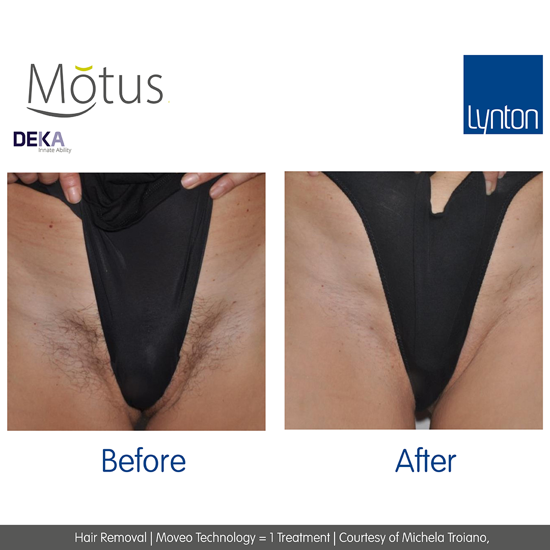 Laser Hair Removal - Main Image